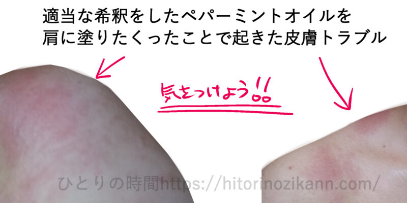 スイートアーモンドオイルとペパーミント精油でアロマイルを適当な希釈をして作ったことで、炎症が起きた話。
