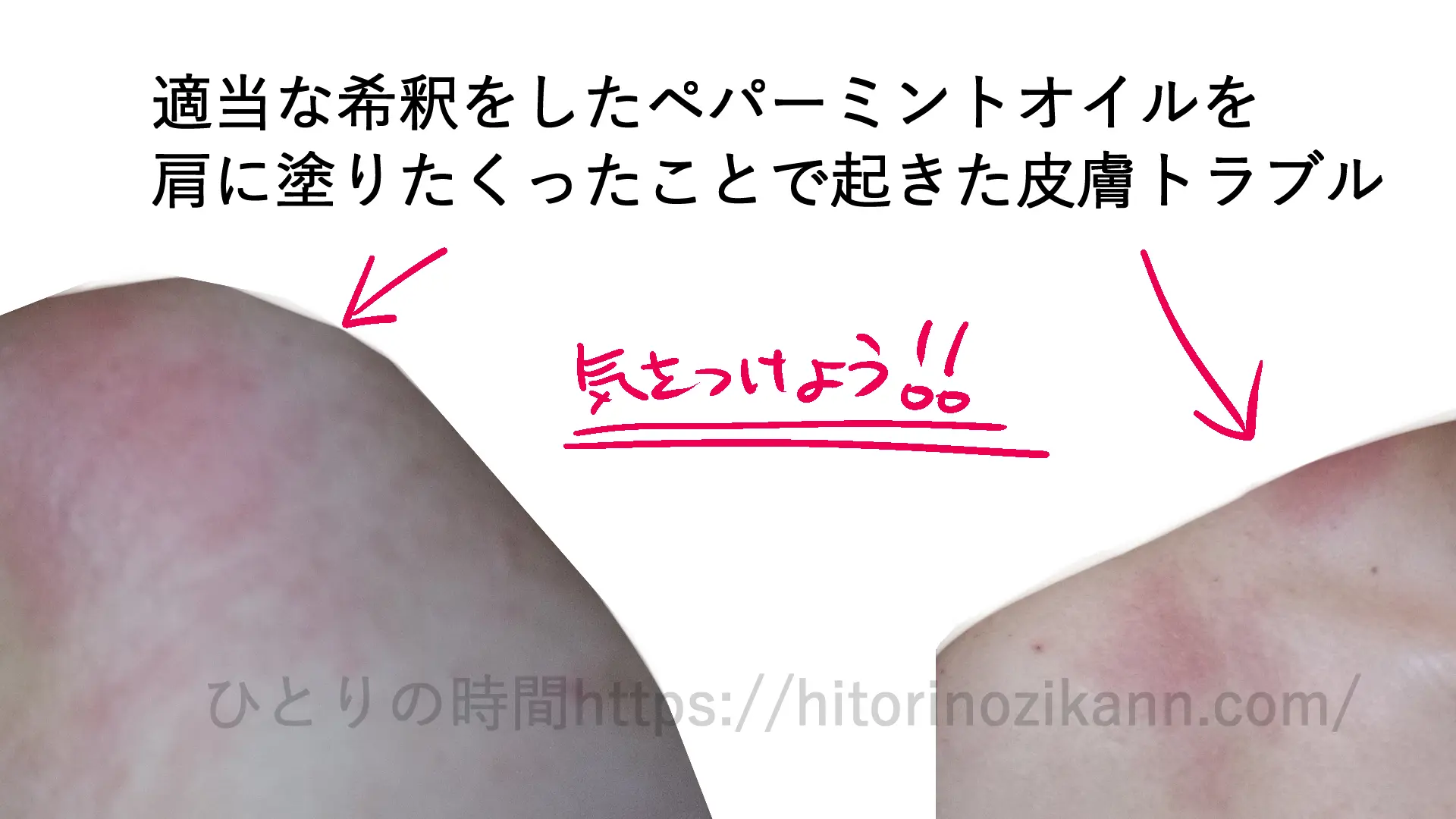 スイートアーモンドオイルとペパーミント精油でアロマイルを適当な希釈をして作ったことで、炎症が起きた話。